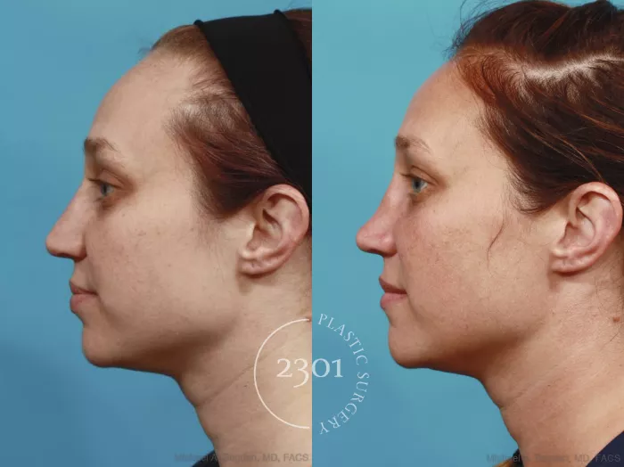 健康・医学 Closed rhinoplasty Closed Rhinoplasty - YouTube