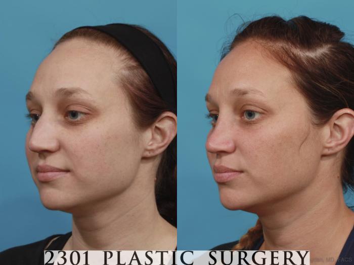 Before & After Rhinoplasty Case 585 View #3 View in Fort Worth, Plano, & Frisco, Texas