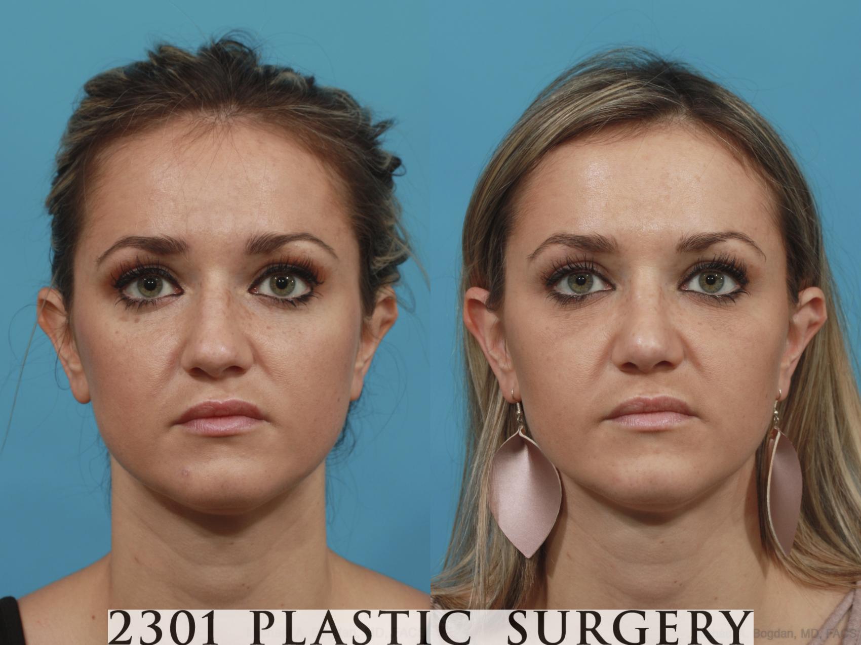 Before & After Rhinoplasty Case 624 Front View in Fort Worth, Plano, & Frisco, Texas