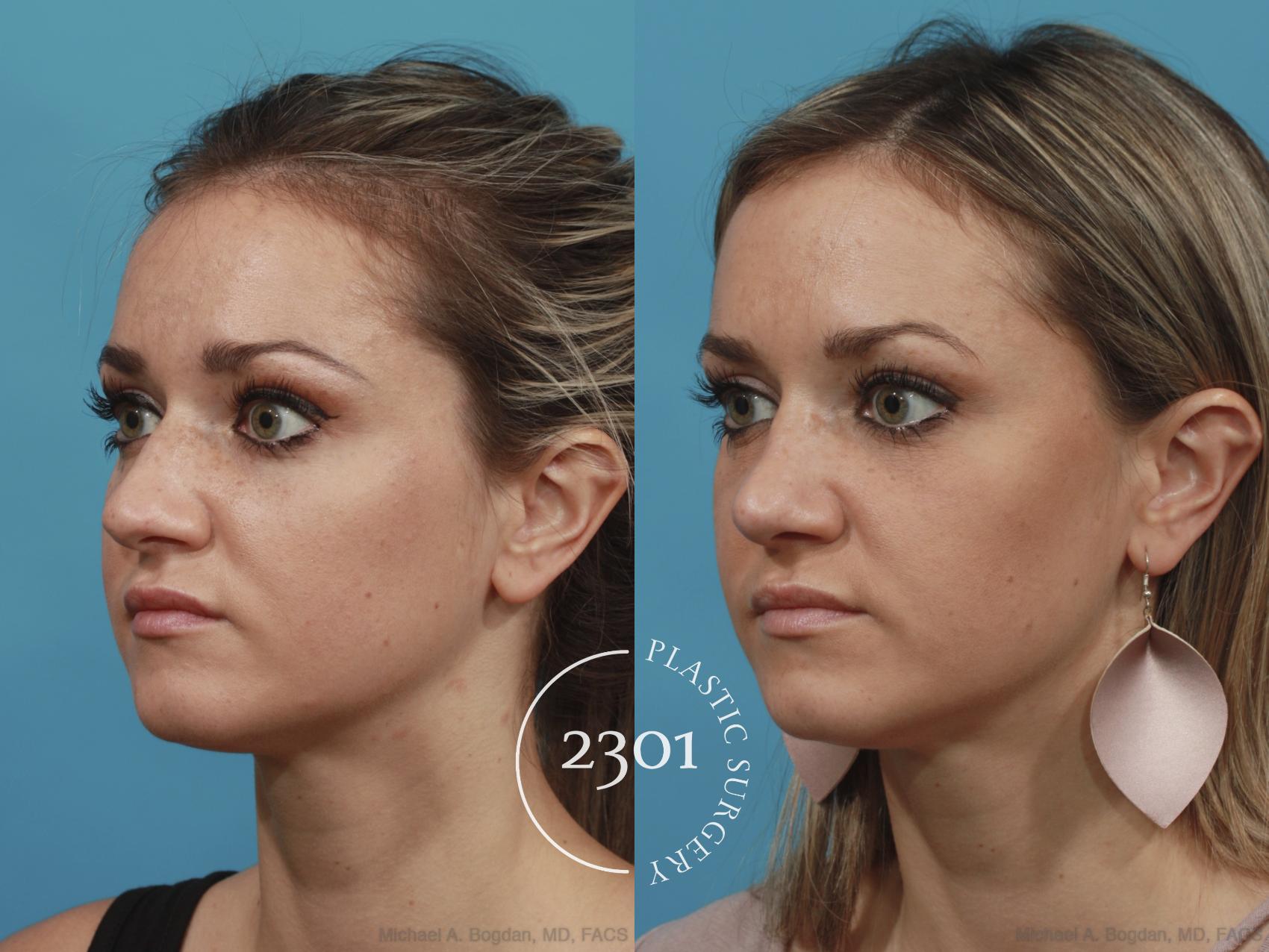 Before & After Rhinoplasty Case 624 Left Oblique View in Fort Worth, Plano, & Frisco, Texas