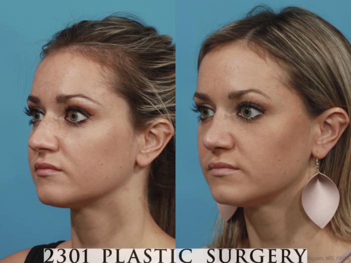 Before & After Rhinoplasty Case 624 Left Oblique View in Fort Worth, Plano, & Frisco, Texas