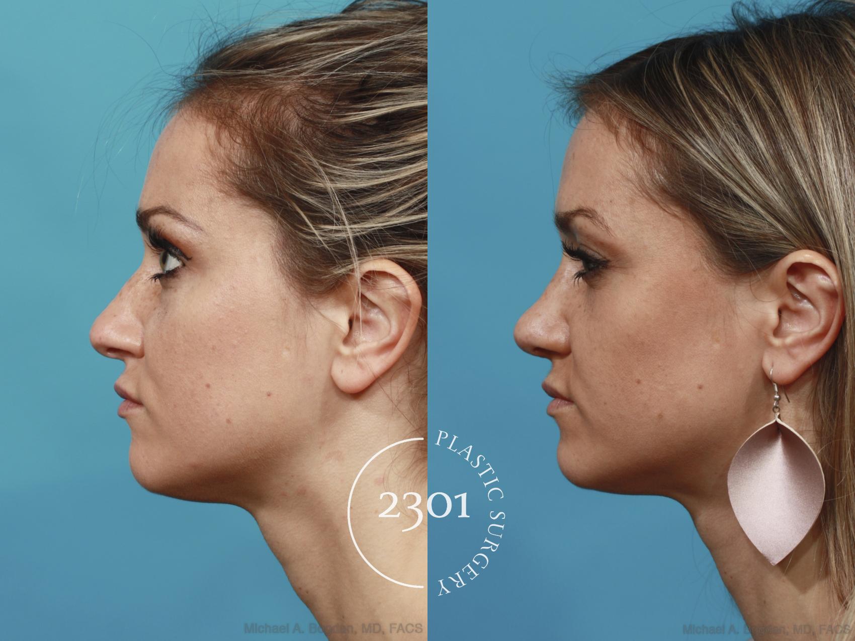 Before & After Rhinoplasty Case 624 Left Side View in Fort Worth, Plano, & Frisco, Texas