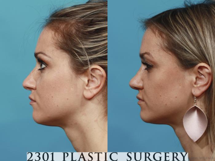 Before & After Rhinoplasty Case 624 Left Side View in Fort Worth, Plano, & Frisco, Texas