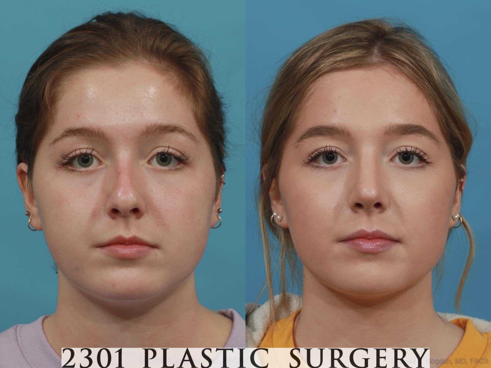 Before & After Rhinoplasty Case 625 Front View in Fort Worth, Plano, & Frisco, Texas