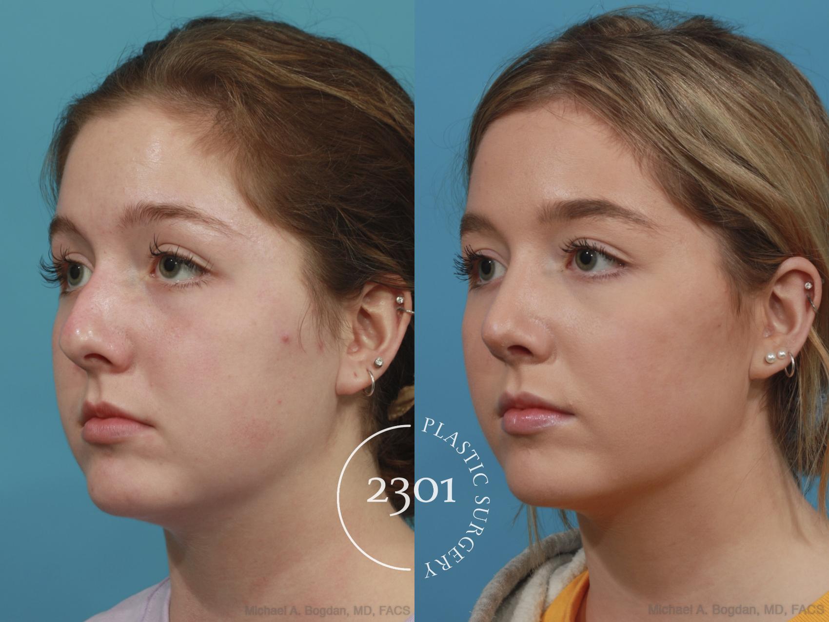 Before & After Rhinoplasty Case 625 Left Oblique View in Fort Worth, Plano, & Frisco, Texas