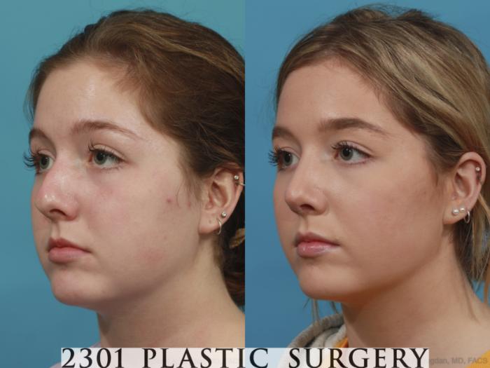 Before & After Rhinoplasty Case 625 Left Oblique View in Fort Worth, Plano, & Frisco, Texas