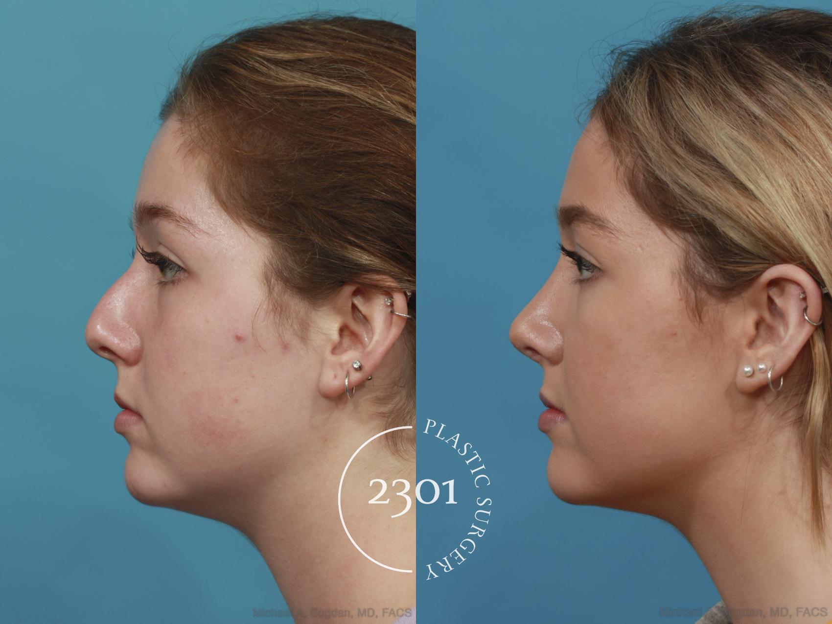 Before & After Rhinoplasty Case 625 Left Side View in Fort Worth, Plano, & Frisco, Texas