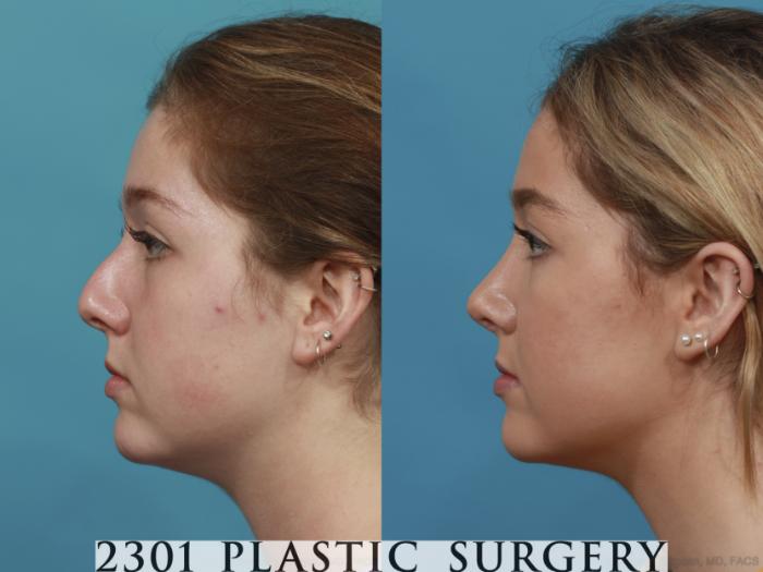 Before & After Rhinoplasty Case 625 Left Side View in Fort Worth, Plano, & Frisco, Texas