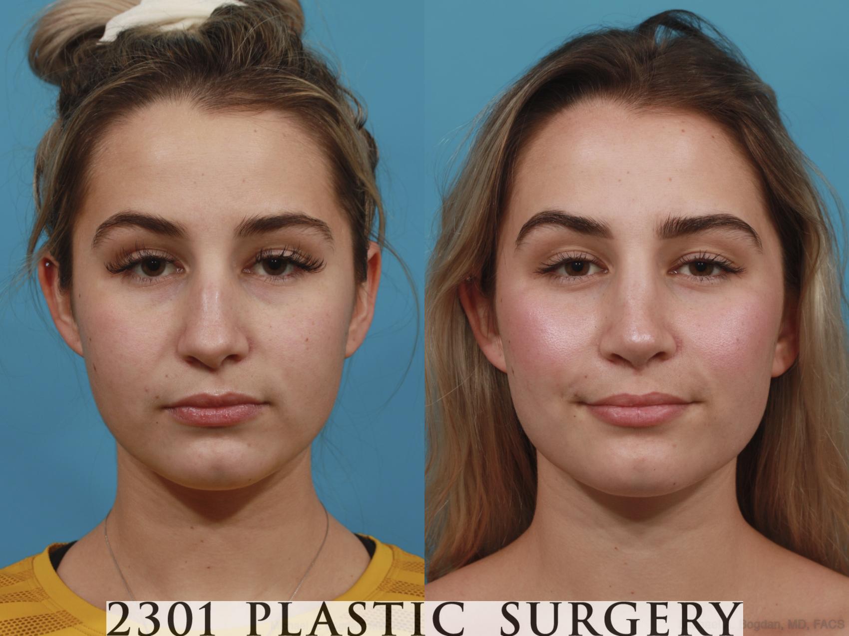 Before & After Rhinoplasty Case 626 Front View in Fort Worth, Plano, & Frisco, Texas