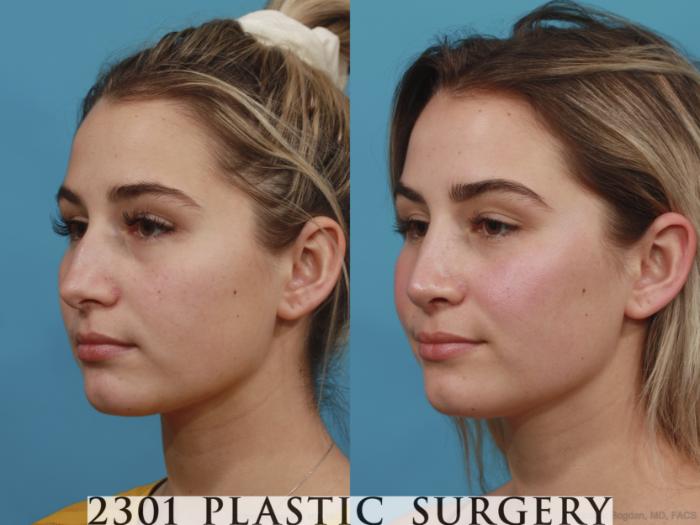 Before & After Rhinoplasty Case 626 Left Oblique View in Fort Worth, Plano, & Frisco, Texas