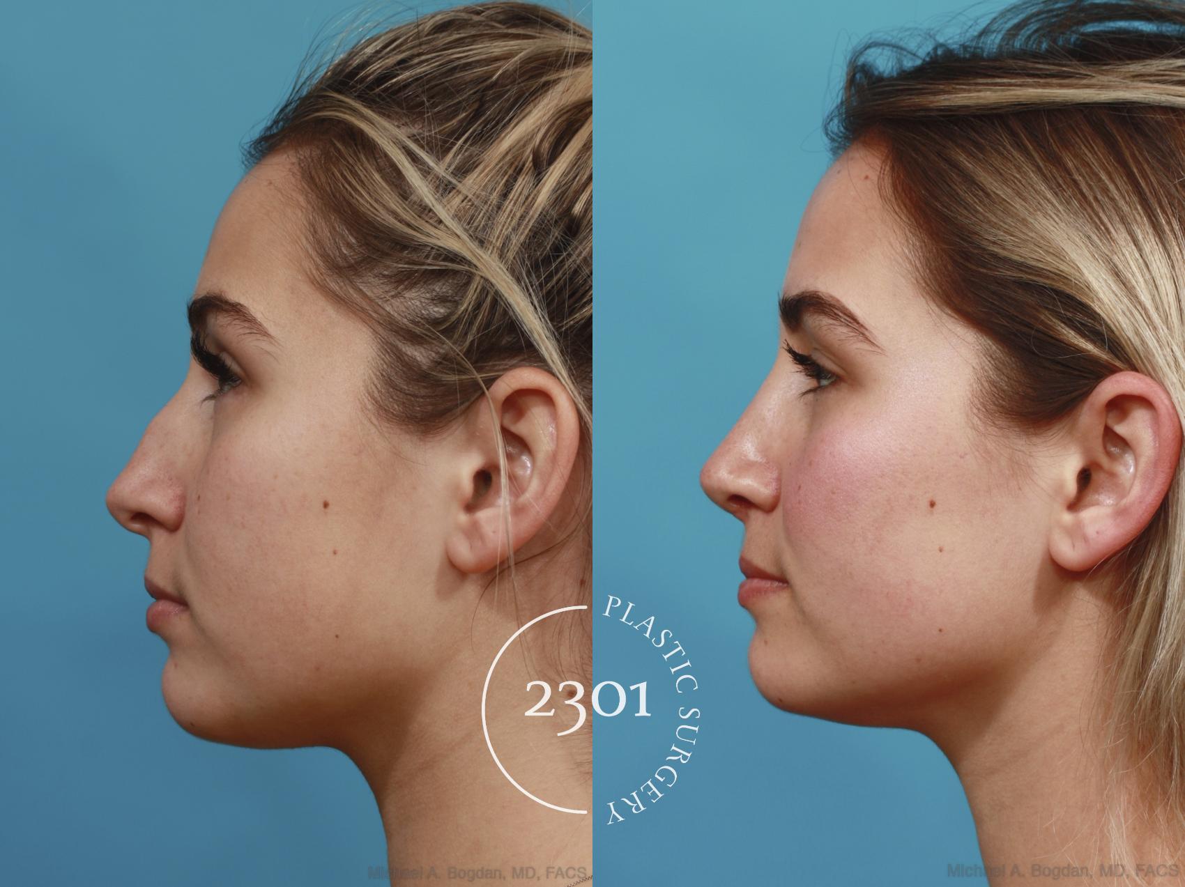 Before & After Rhinoplasty Case 626 Left Side View in Fort Worth, Plano, & Frisco, Texas
