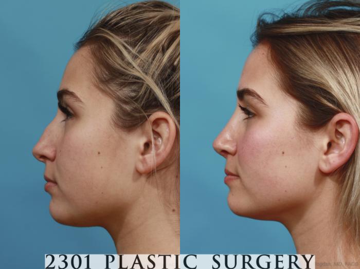 Before & After Rhinoplasty Case 626 Left Side View in Fort Worth, Plano, & Frisco, Texas
