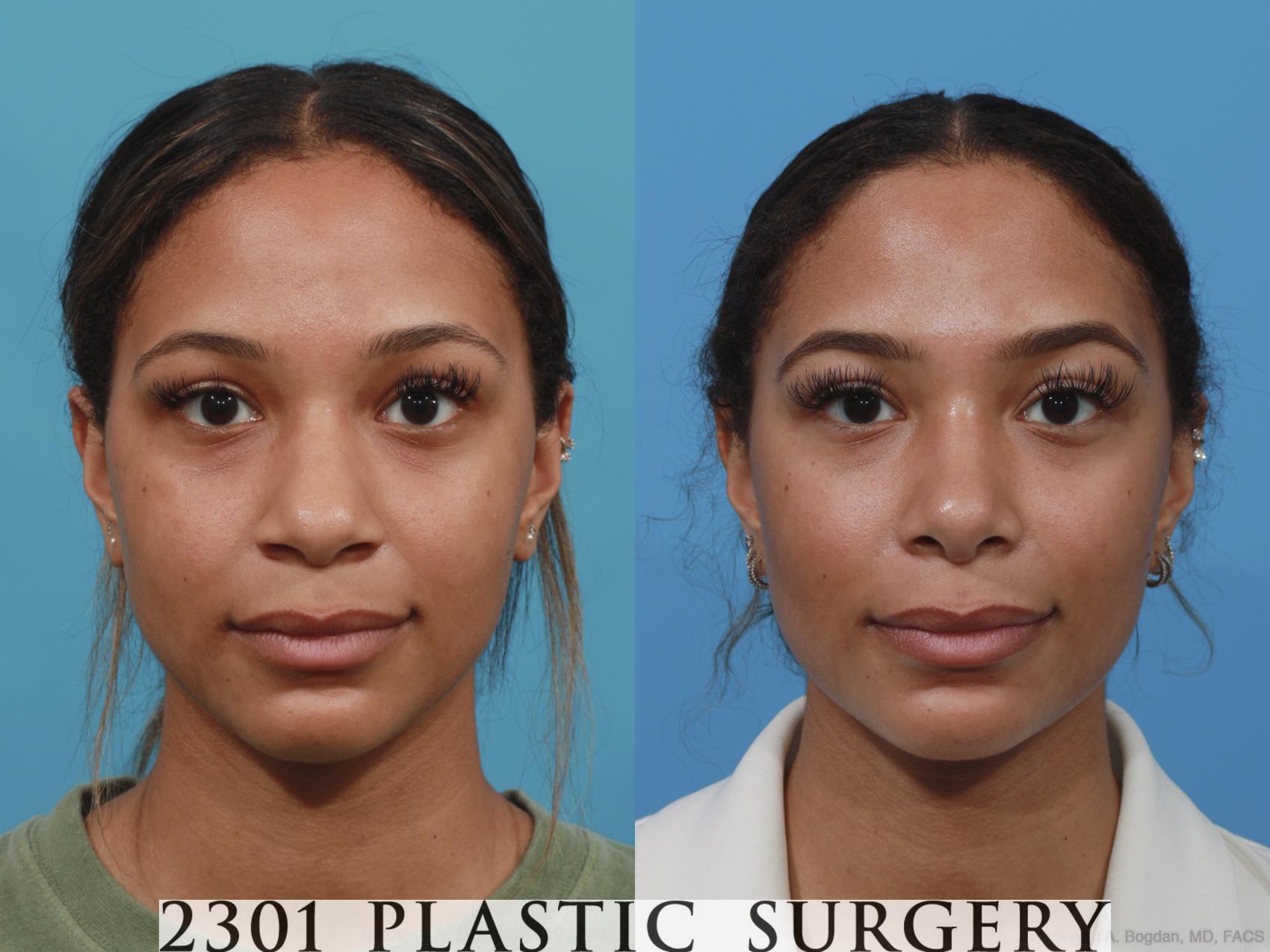 Before & After Rhinoplasty Case 628 Front View in Fort Worth, Plano, & Frisco, Texas