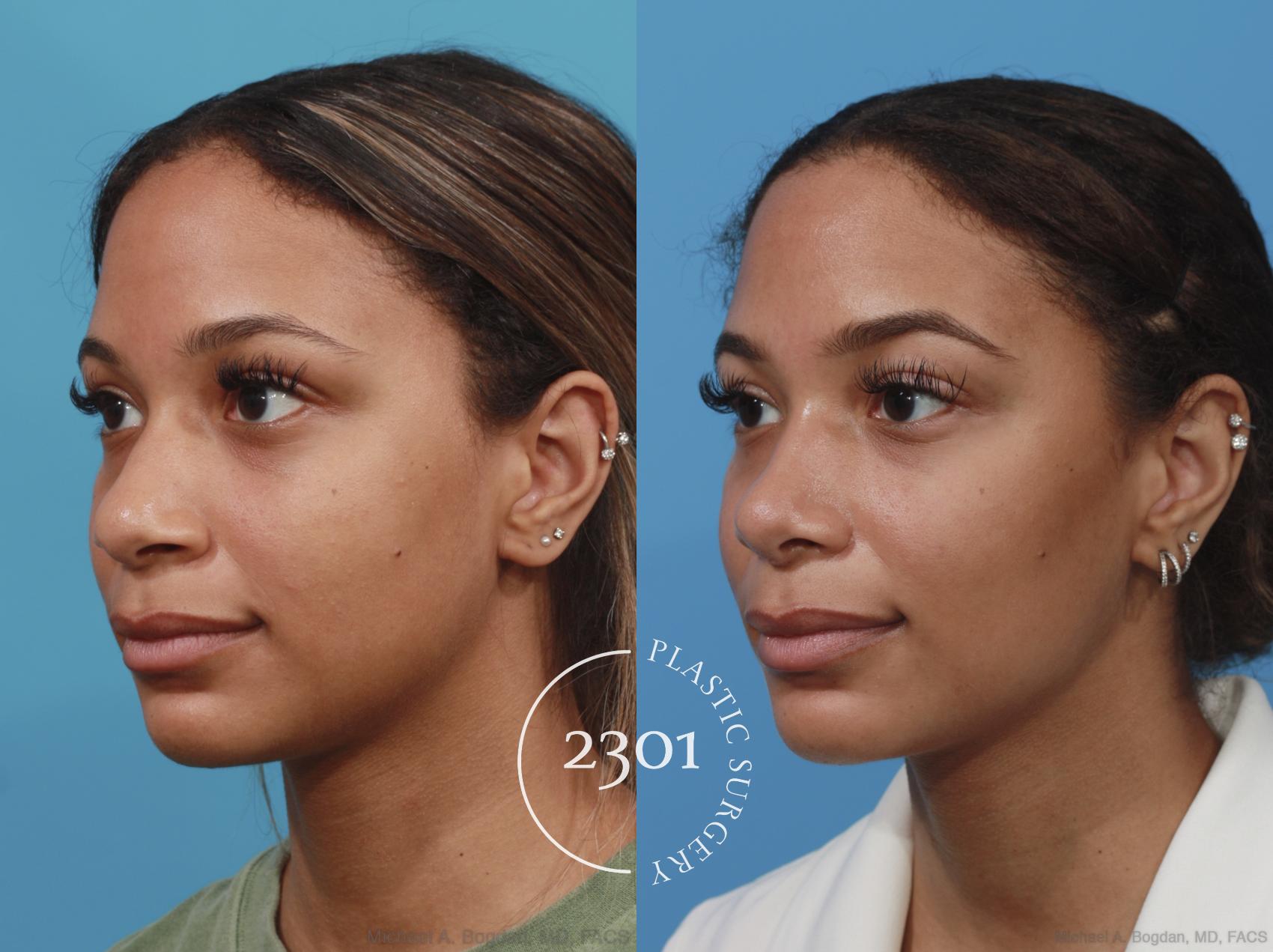 Before & After Rhinoplasty Case 628 Left Oblique View in Fort Worth, Plano, & Frisco, Texas