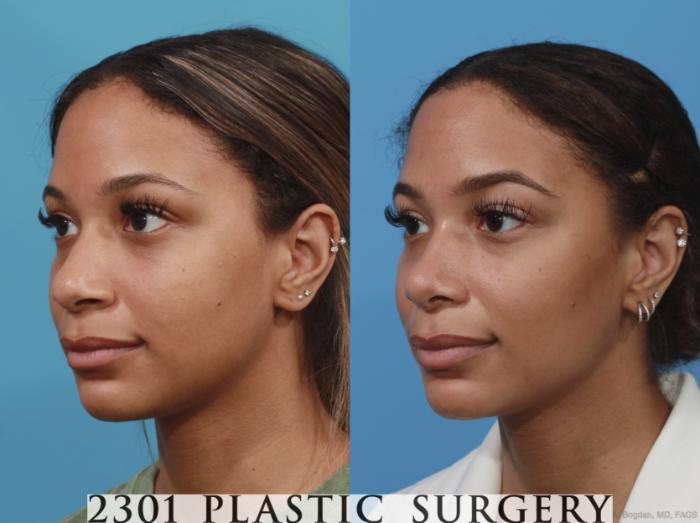 Before & After Rhinoplasty Case 628 Left Oblique View in Fort Worth, Plano, & Frisco, Texas