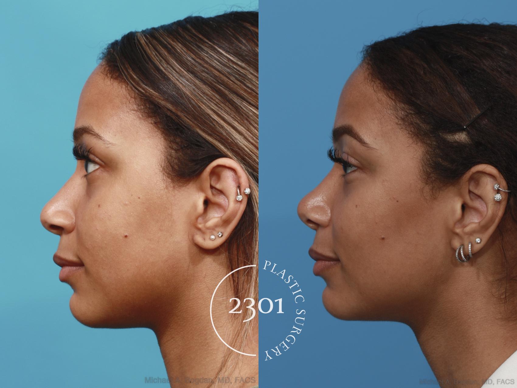 Before & After Rhinoplasty Case 628 Left Side View in Fort Worth, Plano, & Frisco, Texas