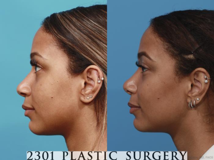Before & After Rhinoplasty Case 628 Left Side View in Fort Worth, Plano, & Frisco, Texas