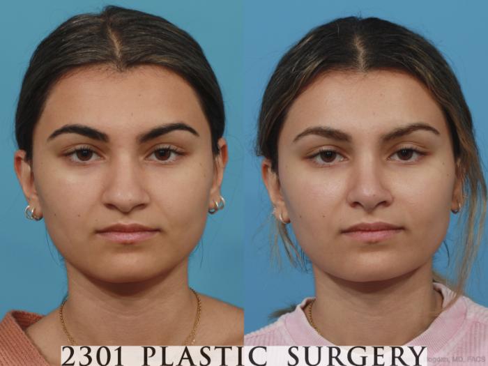 Before & After Rhinoplasty Case 629 Front View in Fort Worth, Plano, & Frisco, Texas
