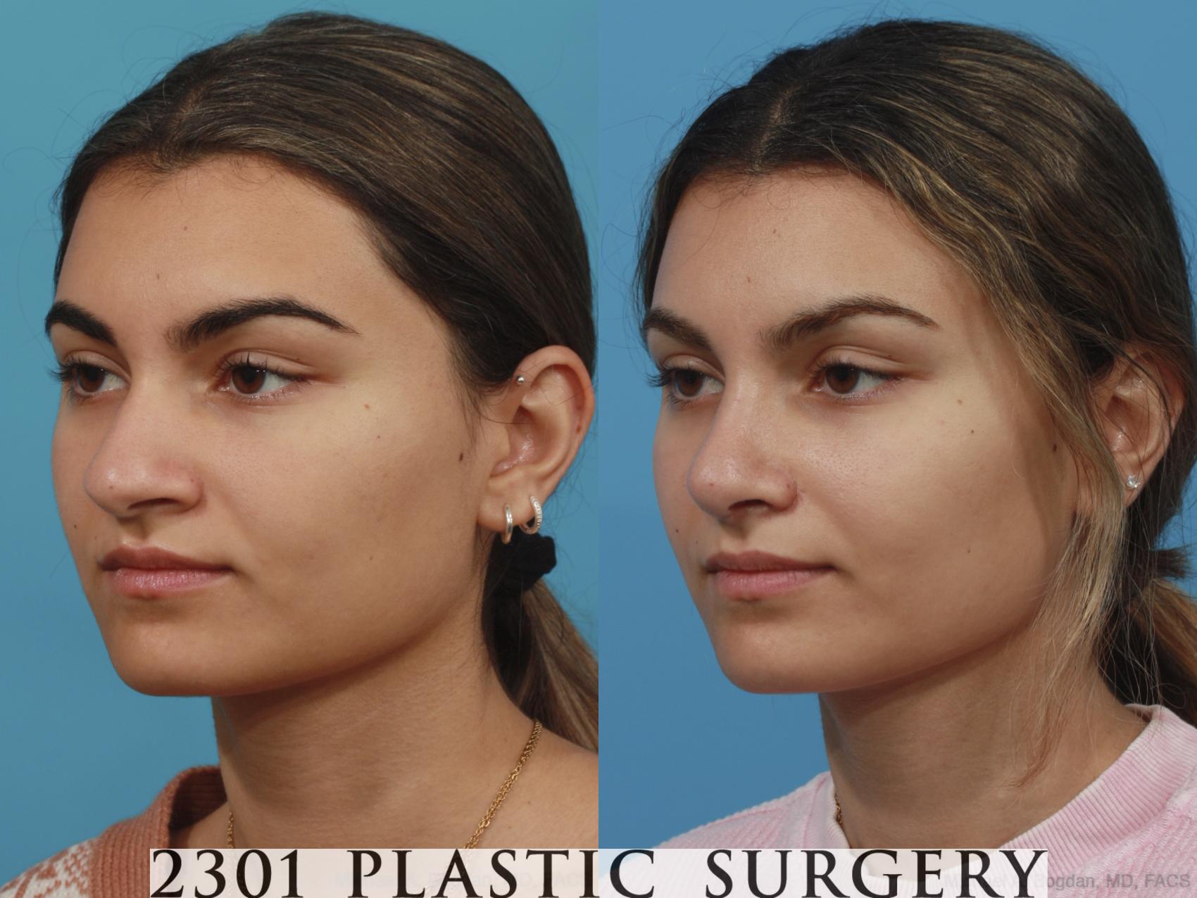 Before & After Rhinoplasty Case 629 Left Oblique View in Fort Worth & Frisco, Texas