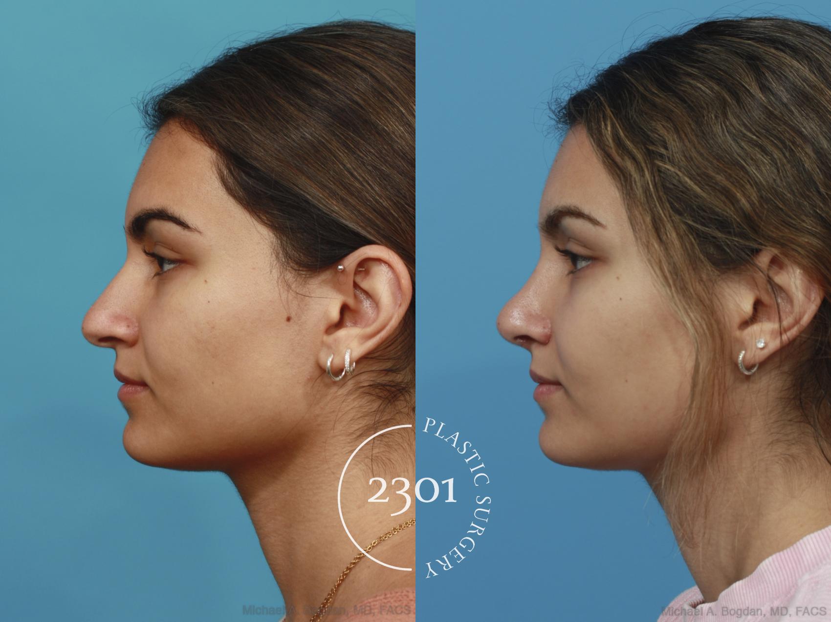 Before & After Rhinoplasty Case 629 Left Side View in Fort Worth, Plano, & Frisco, Texas