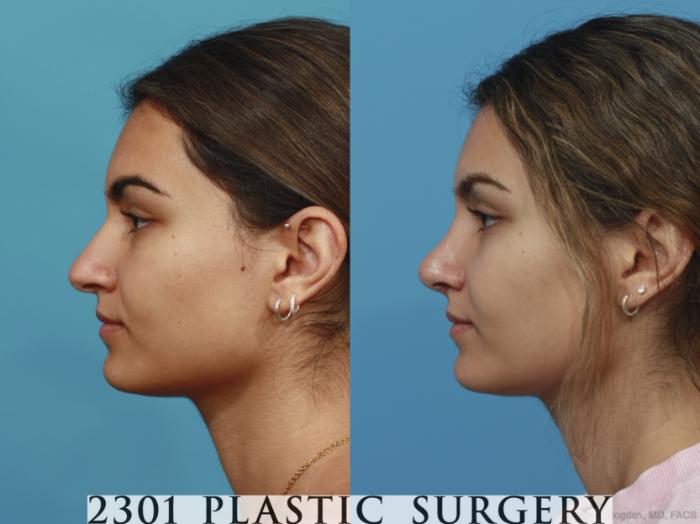 Before & After Rhinoplasty Case 629 Left Side View in Fort Worth, Plano, & Frisco, Texas