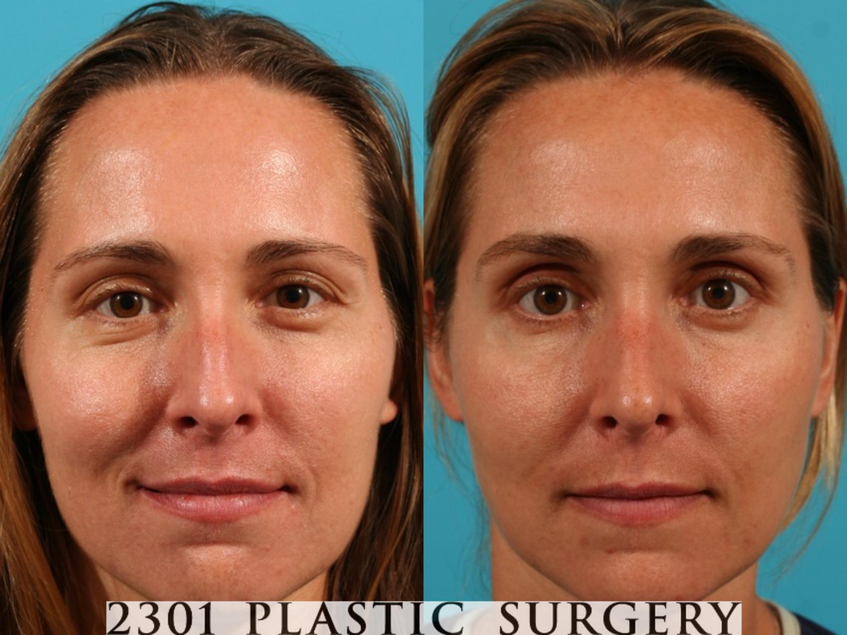 Before & After Rhinoplasty Case 63 View #1 View in Fort Worth, Plano, & Frisco, Texas