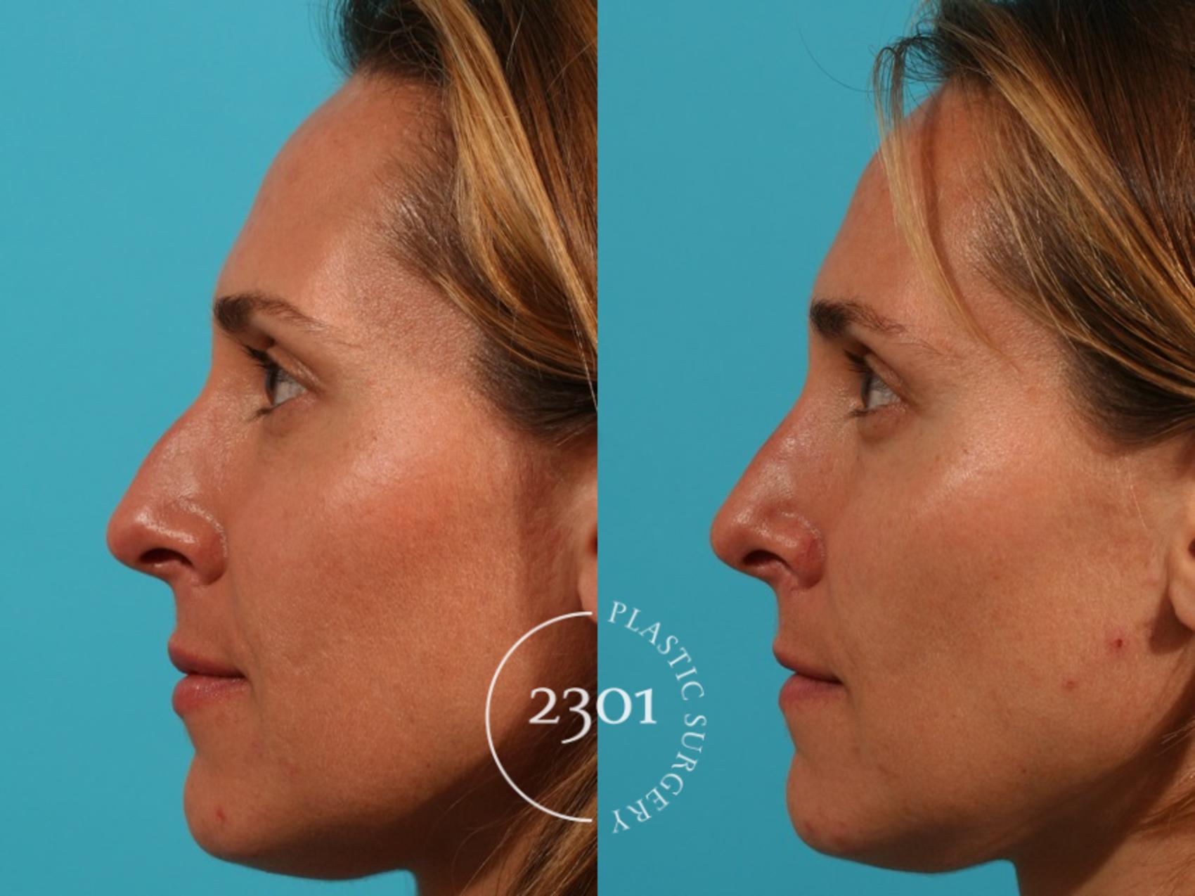Before & After Rhinoplasty Case 63 View #2 View in Fort Worth, Plano, & Frisco, Texas