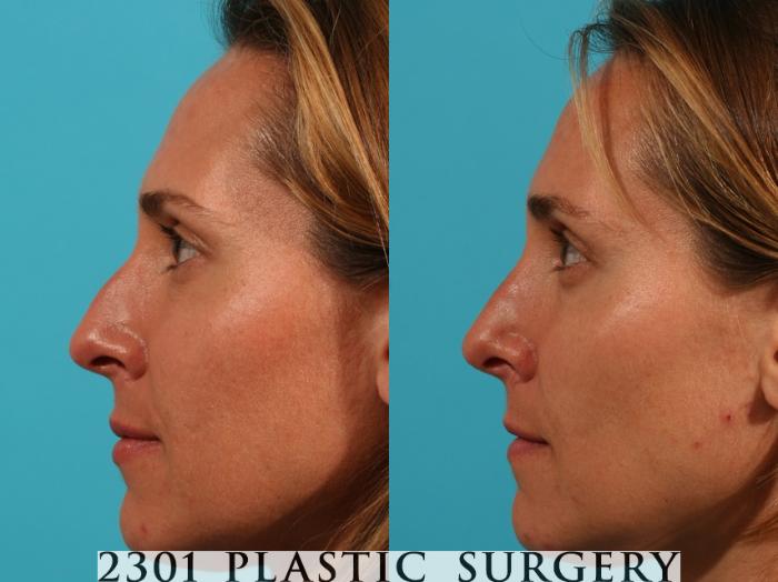 Before & After Rhinoplasty Case 63 View #2 View in Fort Worth, Plano, & Frisco, Texas