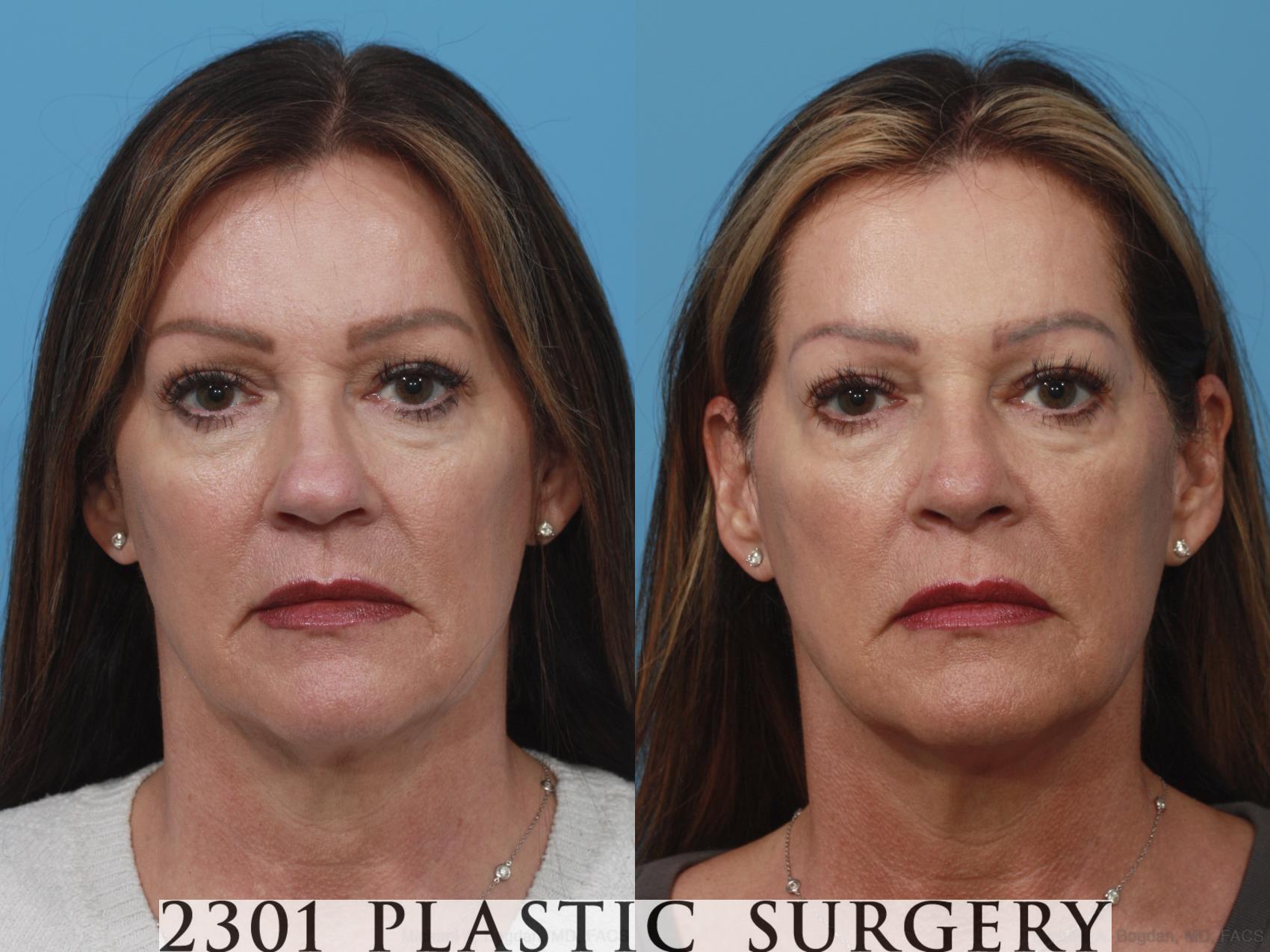 Before & After Rhinoplasty Case 630 Front View in Fort Worth, Plano, & Frisco, Texas