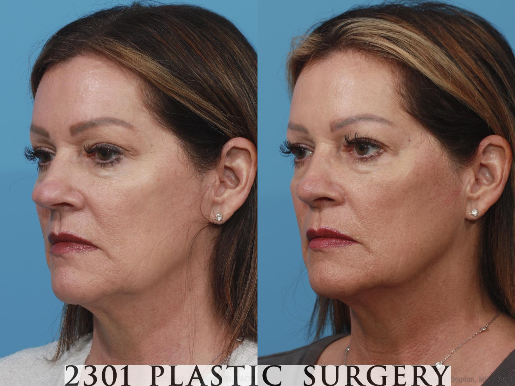 Before & After Rhinoplasty Case 630 Left Oblique View in Fort Worth, Plano, & Frisco, Texas