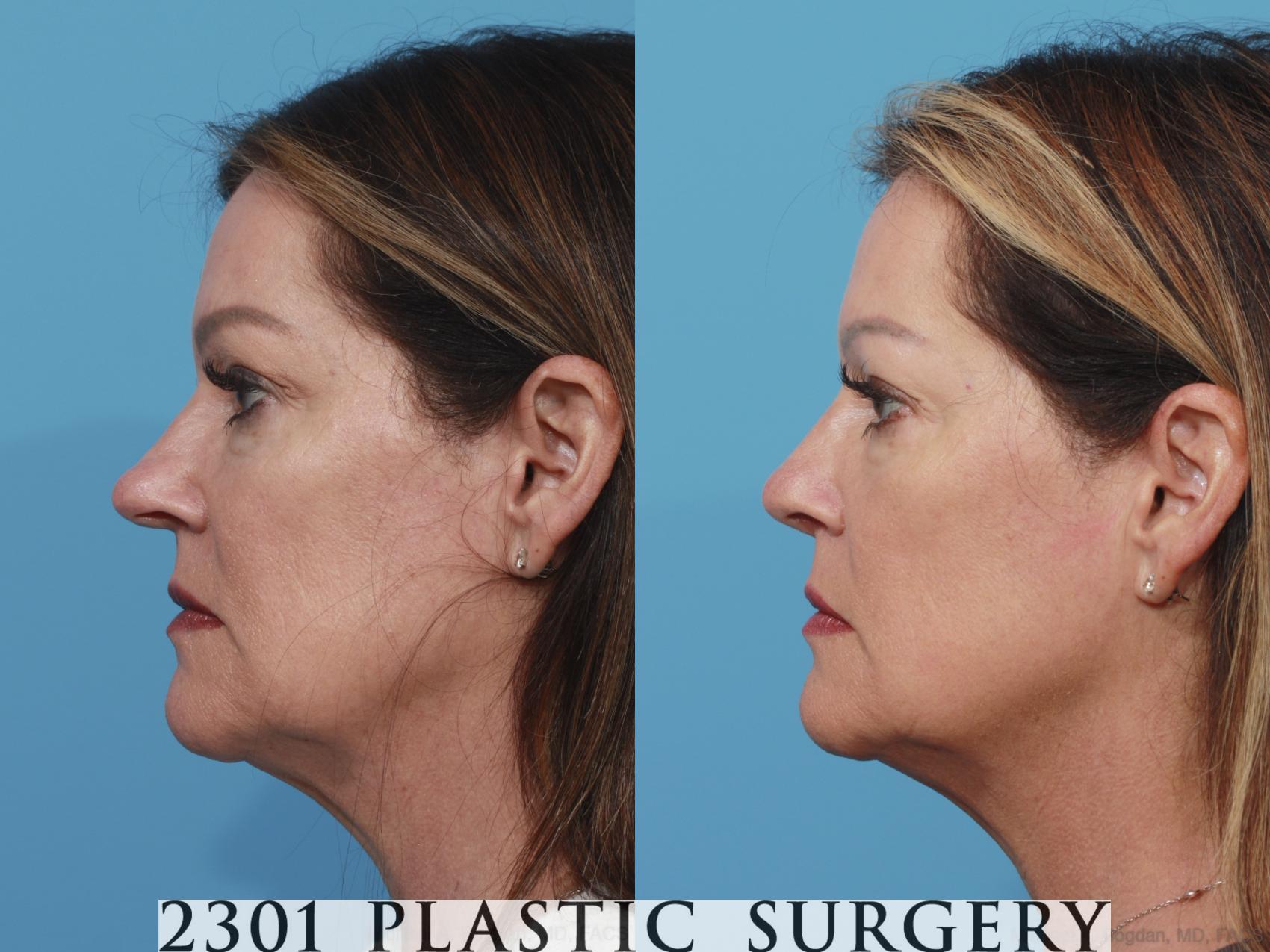 Before & After Rhinoplasty Case 630 Left Side View in Fort Worth, Plano, & Frisco, Texas