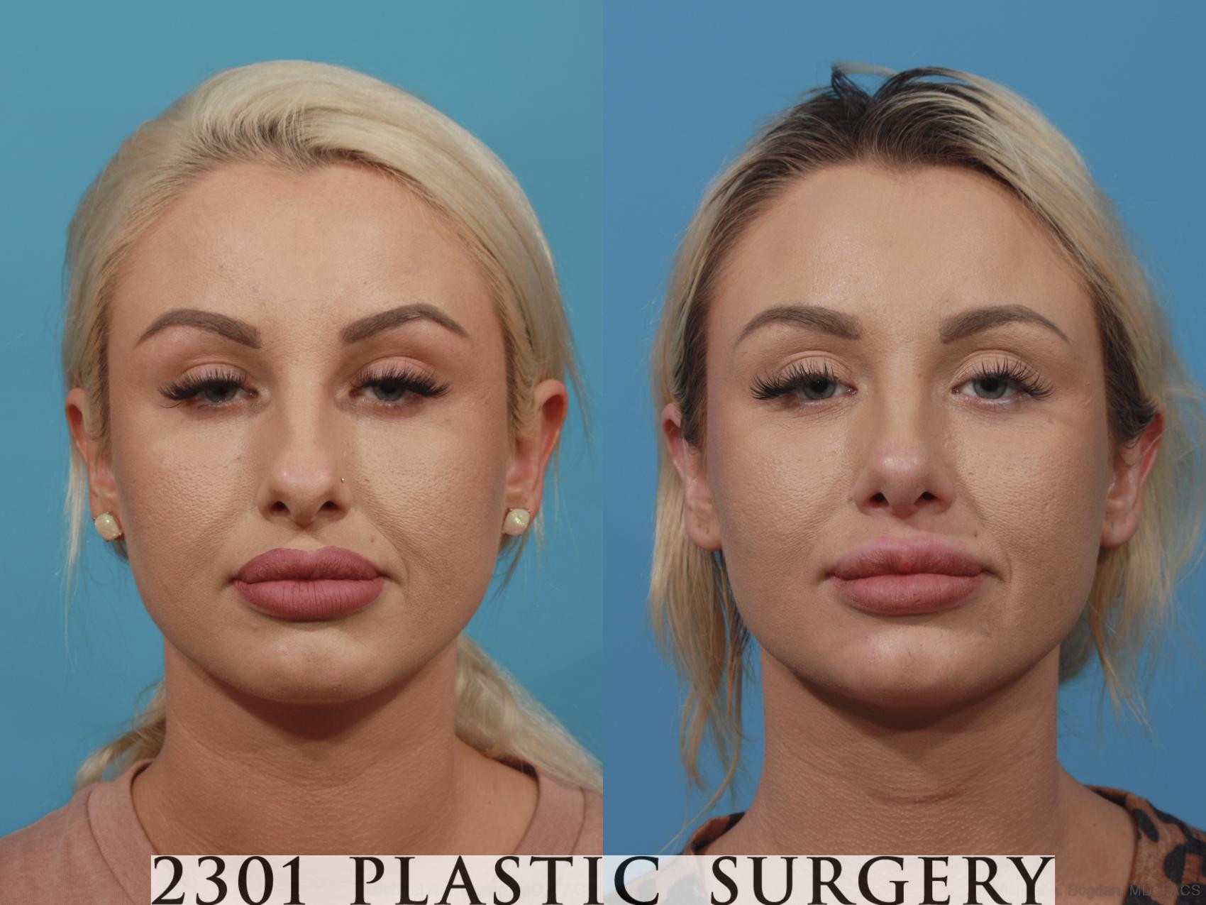 Before & After Rhinoplasty Case 631 Front View in Fort Worth, Plano, & Frisco, Texas