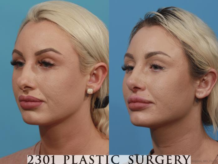 Before & After Rhinoplasty Case 631 Left Oblique View in Fort Worth, Plano, & Frisco, Texas