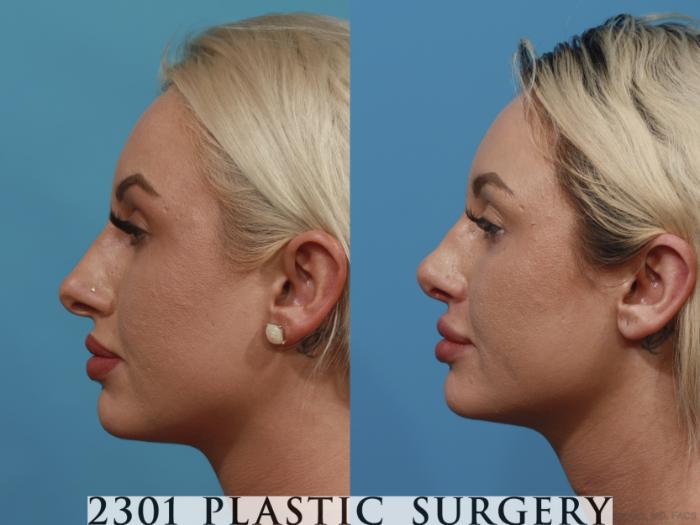 Before & After Rhinoplasty Case 631 Left Side View in Fort Worth, Plano, & Frisco, Texas