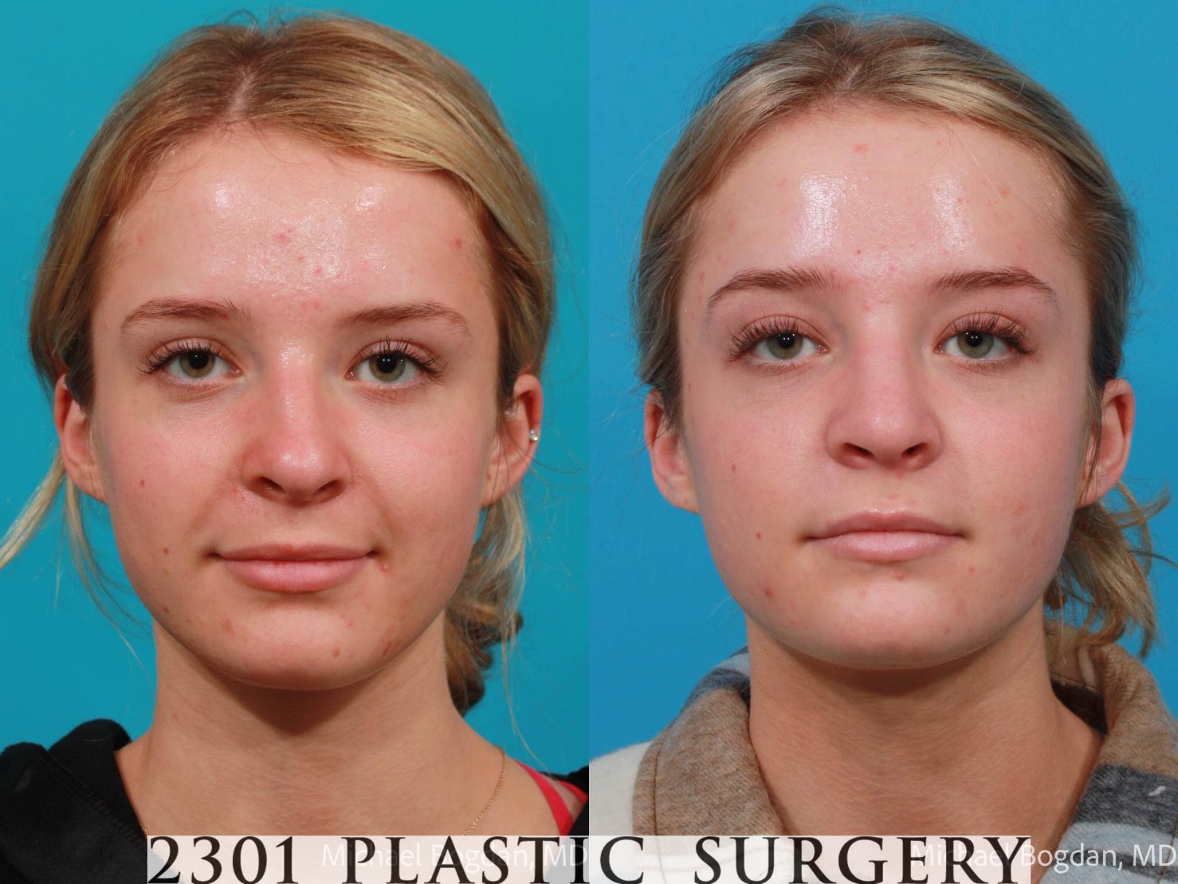 Before & After Rhinoplasty Case 679 Front View in Fort Worth & Frisco, Texas