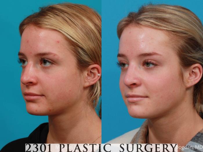 Before & After Rhinoplasty Case 679 Left Oblique View in Fort Worth, Plano, & Frisco, Texas
