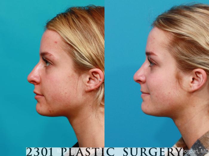 Before & After Rhinoplasty Case 679 Left Side View in Fort Worth, Plano, & Frisco, Texas