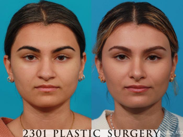 Before & After Rhinoplasty Case 684 Front View in Fort Worth, Plano, & Frisco, Texas