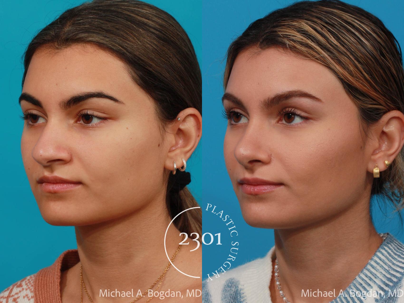 Before & After Rhinoplasty Case 684 Left Oblique View in Fort Worth, Plano, & Frisco, Texas