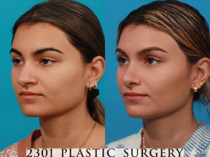 Before & After Rhinoplasty Case 684 Left Oblique View in Fort Worth, Plano, & Frisco, Texas