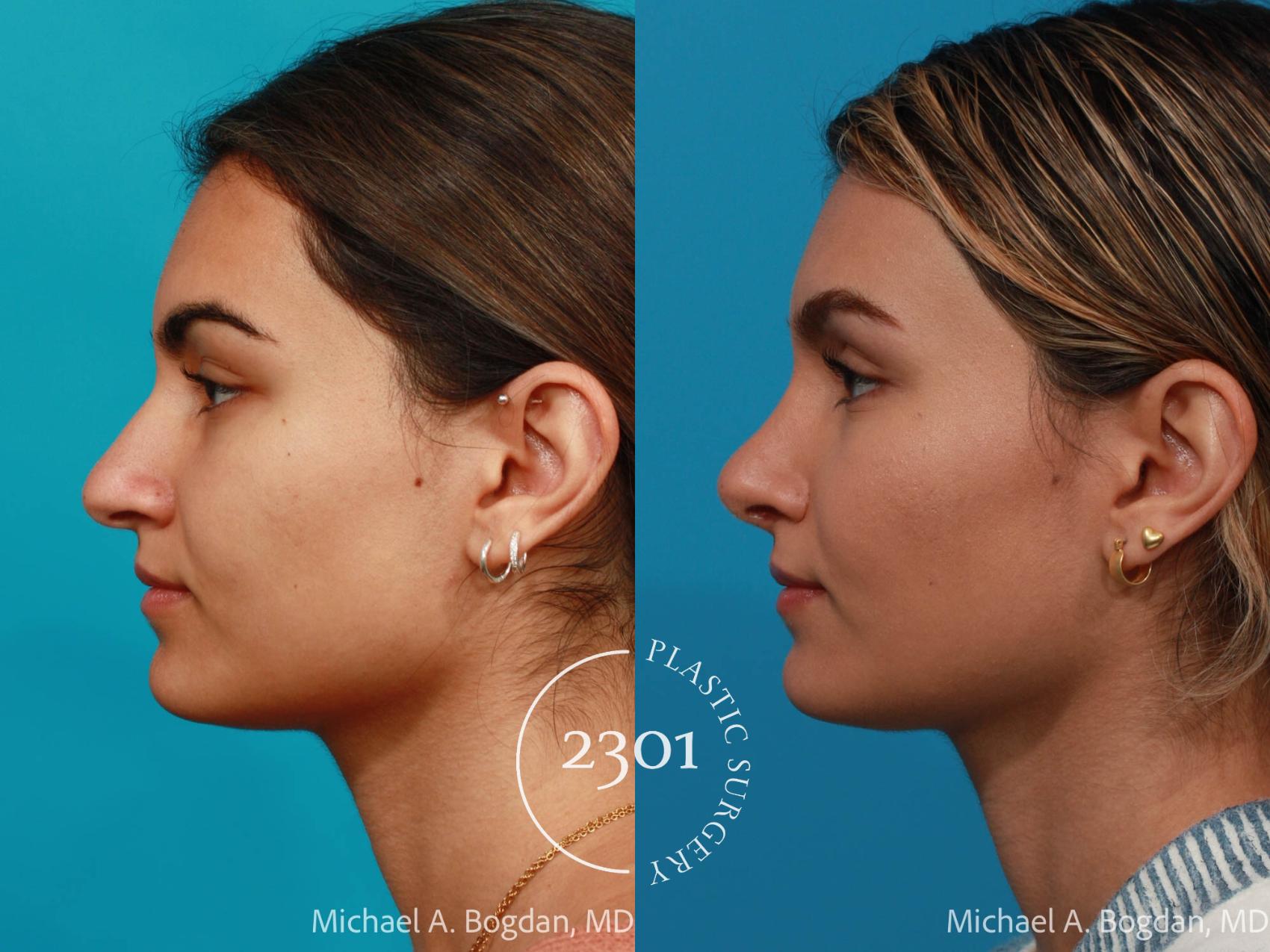 Before & After Rhinoplasty Case 684 Left Side View in Fort Worth, Plano, & Frisco, Texas