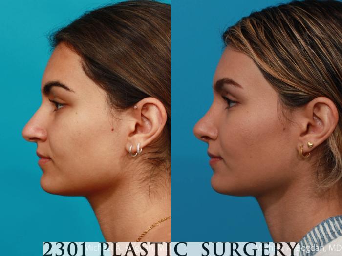 Before & After Rhinoplasty Case 684 Left Side View in Fort Worth, Plano, & Frisco, Texas