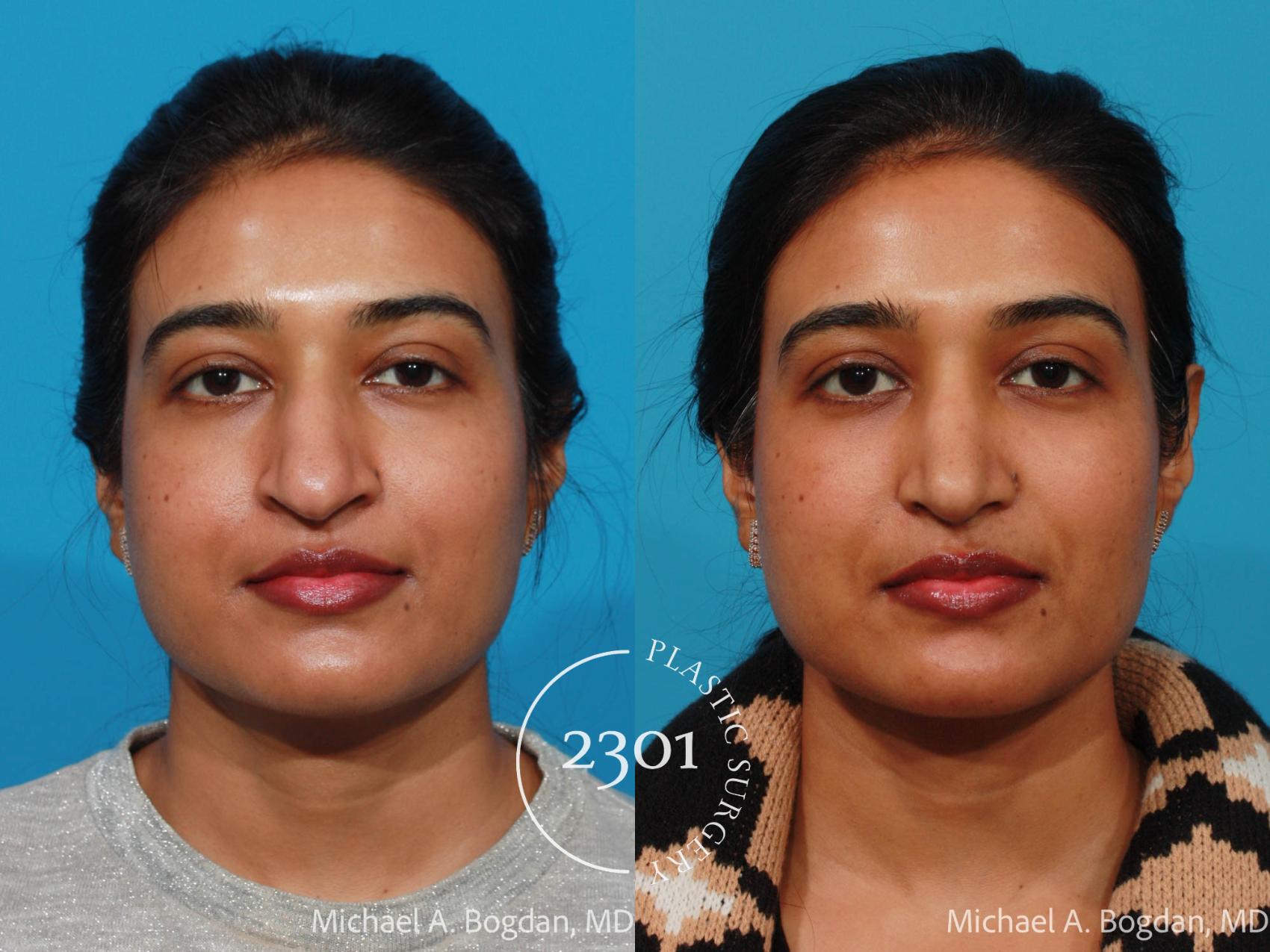 Before & After Rhinoplasty Case 721 Front View in Fort Worth, Plano, & Frisco, Texas