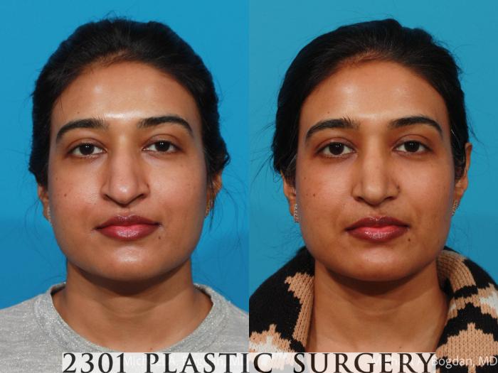 Before & After Rhinoplasty Case 721 Front View in Fort Worth, Plano, & Frisco, Texas