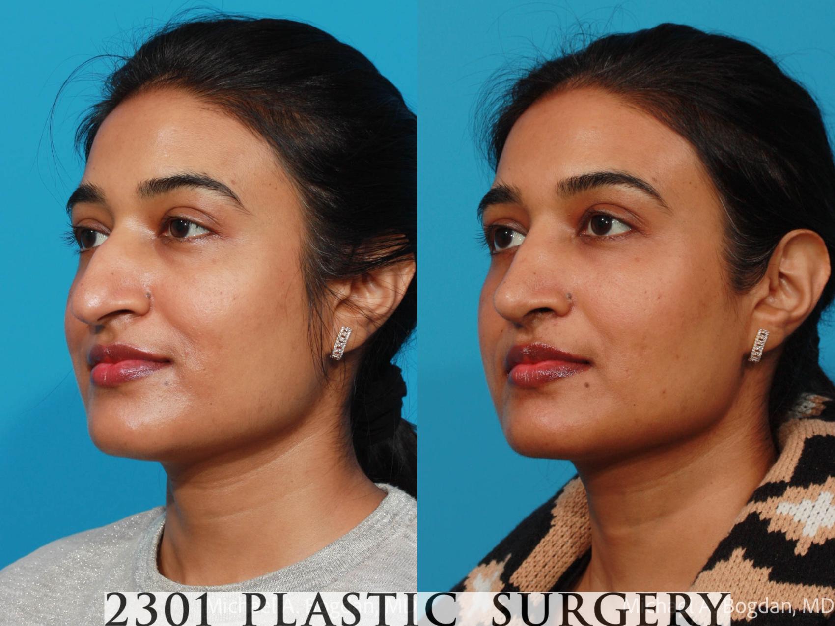 Before & After Rhinoplasty Case 721 Left Oblique View in Fort Worth, Plano, & Frisco, Texas