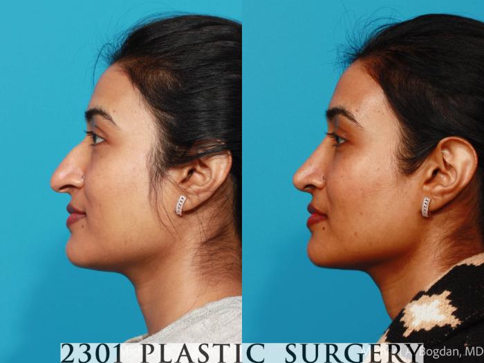 Before & After Rhinoplasty Case 721 Left Side View in Fort Worth, Plano, & Frisco, Texas