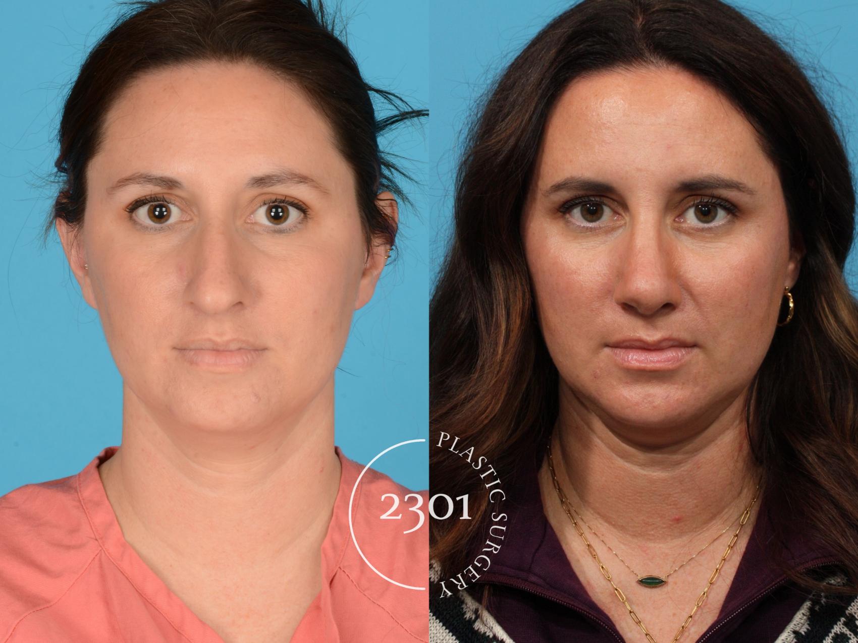 Before & After Rhinoplasty Case 732 Front View in Fort Worth, Plano, & Frisco, Texas