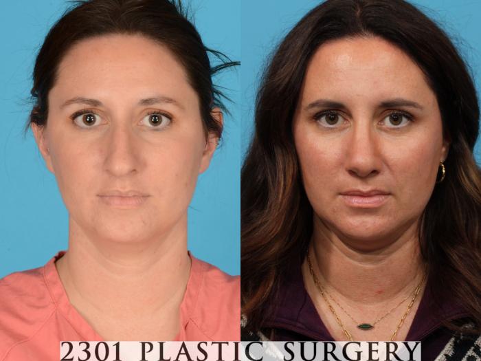 Before & After Rhinoplasty Case 732 Front View in Fort Worth, Plano, & Frisco, Texas