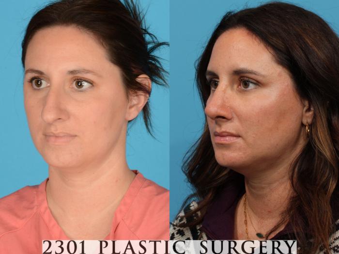 Before & After Rhinoplasty Case 732 Left Oblique View in Fort Worth, Plano, & Frisco, Texas