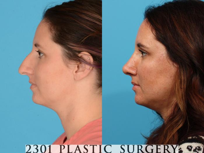 Before & After Rhinoplasty Case 732 Left Side View in Fort Worth, Plano, & Frisco, Texas